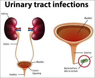 Urinary Tract Infections (UTI) - Prevention and Management