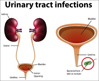 Pregnancy and urinary tract infections (UTIs).