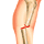 leg_fracture.gif